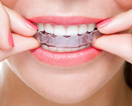 A close-up image shows a person’s mouth as they are inserting a clear dental aligner over their teeth, showcasing healthy white teeth and pink lips.
