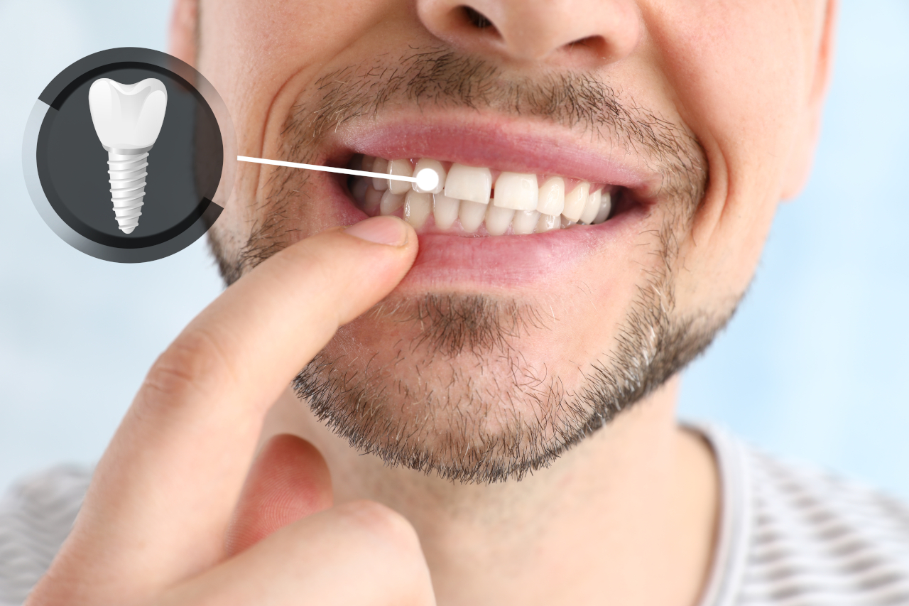 All-on-X Dental Implants in Woodbridge, VA: A Guide to Full-Arch Tooth Replacement