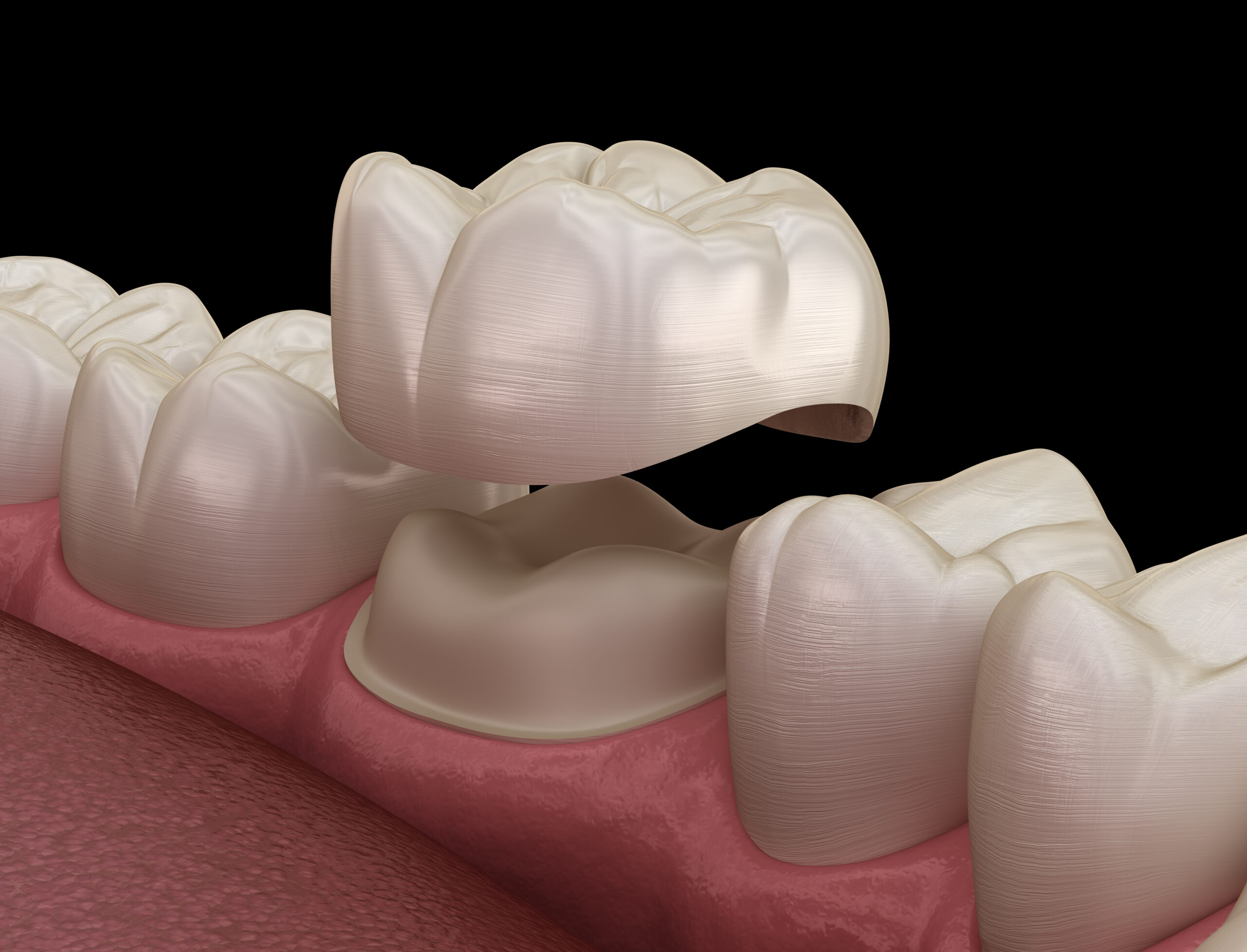 Dental Crowns in Woodbridge, VA: When Does a Tooth Need a Crown?