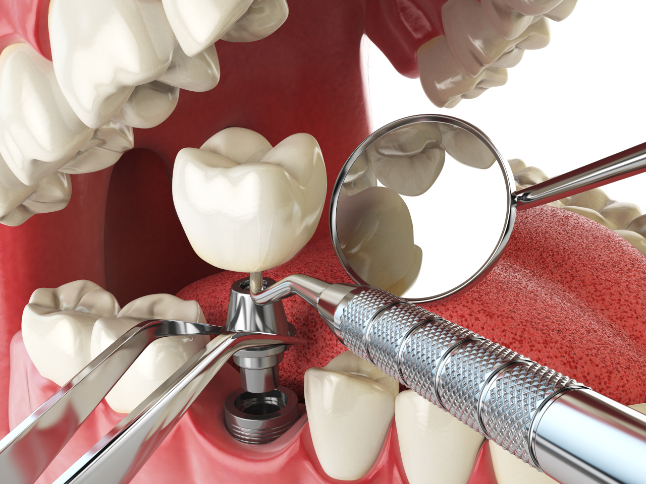 Am I a Candidate for Dental Implants? 8 Factors Your Dentist Will Consider